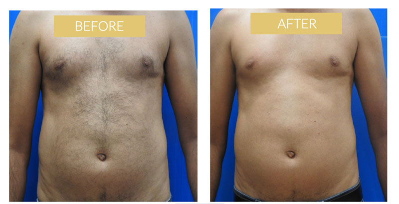 male laser hair removal effect Dublin